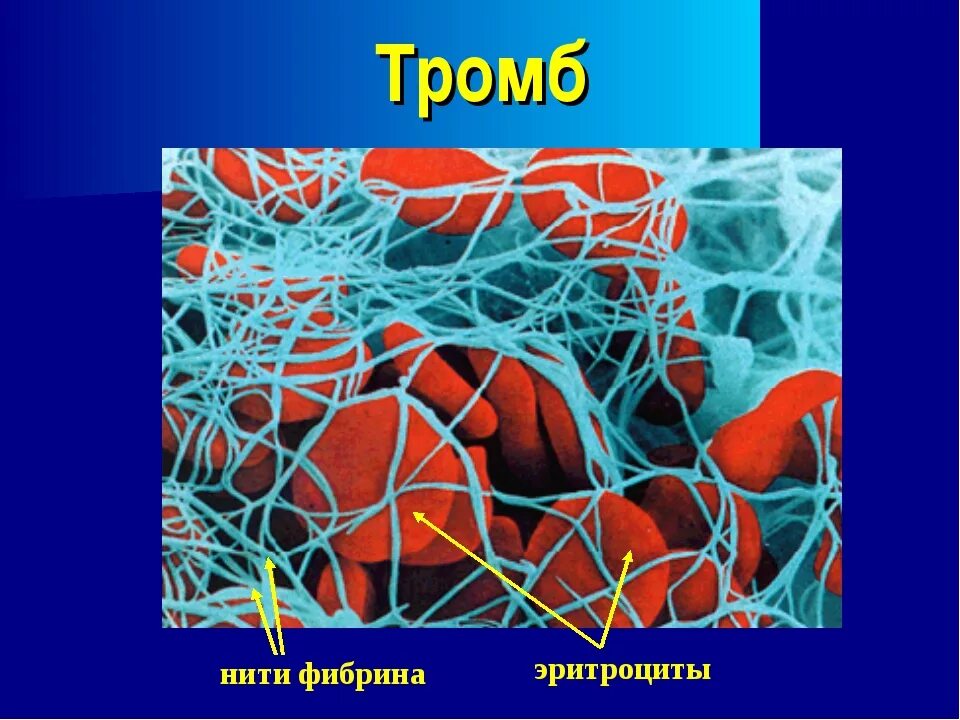 Фибрин функция белка. Эритроциты застрявшие в нитях фибрина.
