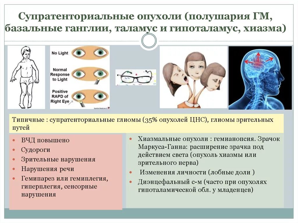 Супратенториальные структуры что это. Супратенториальные опухоли головного мозга. опухоли головного мозга супратенториальные субтенториальные. супратенториальные структуры в головном мозге что это. опухоли супратенториальной локализации.