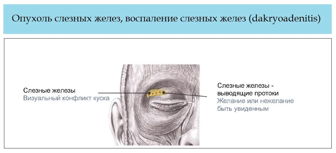 Лечение слезной железы. Воспаление слёзных желёз. Воспаление слезных желез. Новообразование в слезной железе.