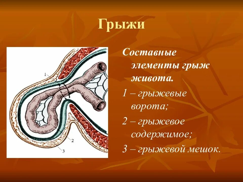 Стенка грыжевого мешка. Строение грыжевого мешка. строение наружной грыжи живота. составные элементы грыжи. составные части наружной грыжи живота.