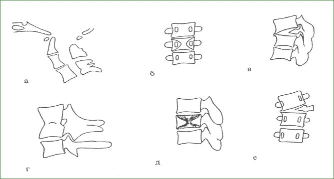 Аномалия развития тел позвонков шейного отдела. Аномалии развития тел позвонков схема. Аномалия развития позвонков грудного отдела. Аномалии развития позвонков бабочковидный.