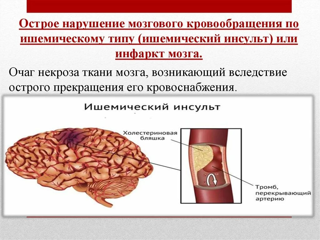 Очаг ишемии мозга. Инсульт острое нарушение мозгового кровообращения. Острое нарушение мозгового кровообращения по ишемическому типу. Очаг ишемического инсульта. ОНМК по ишемическому типу.