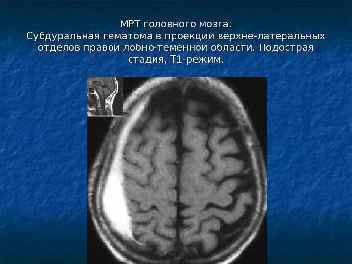 Гематома лобной. Подострая субдуральная гематома на кт. подострая эпидуральная гематома. субдуральная гематома правой височно теменной области.