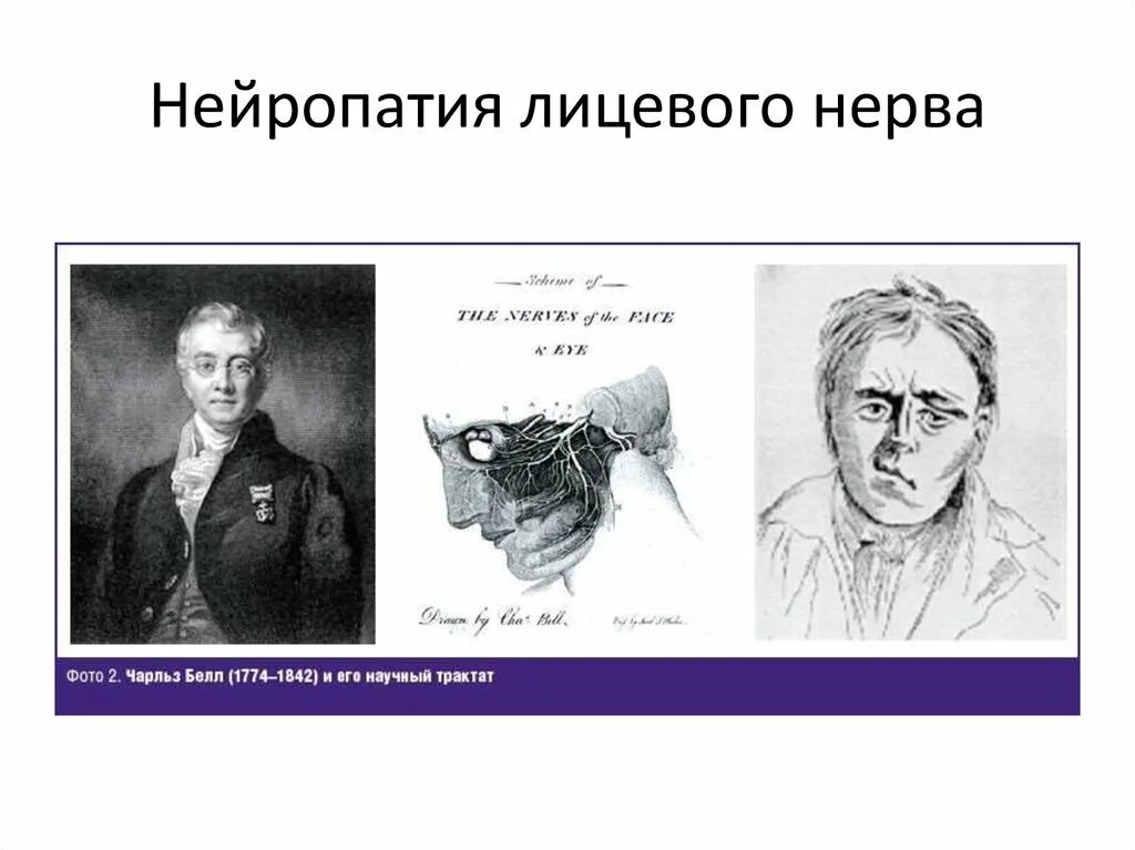 Нейропатия лицевого нерва. Посттравматическая нейропатия лицевого нерва. Острая нейропатия лицевого нерва. Нейропатия лицевого нерва картинки.