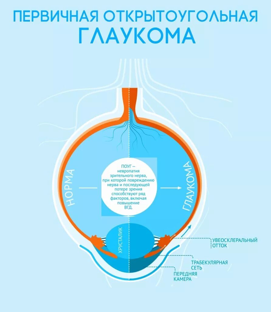 Открытоугольная и закрытоугольная глаукома их. Поля зрения при открытоугольной глаукоме. Открытоугольная глаукома это. Первичная открытоугольная глаукома осложнения. Открытоугольная глаукома.