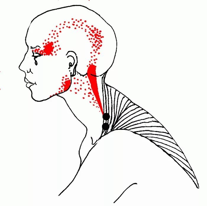 Миофасциальный триггерные точки. Триггерные точки при головной боли. Триггерные точки головы и шеи. Триггерные точки на голове. Боль под затылком