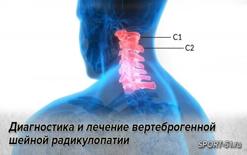 Радикулопатия с6. Шейная радикулопатия. Вертеброгенные радикулопатии. Лечение вертеброгенной радикулопатии.