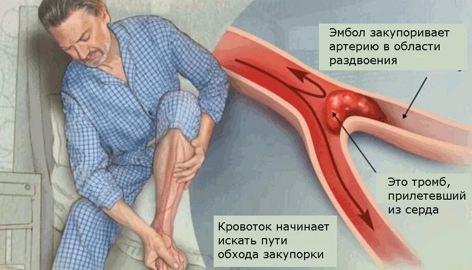 Тромбозы и эмболии артерий. Острые артериальные тромбозы и эмболии. Острая артериальная тромбоэмболия.