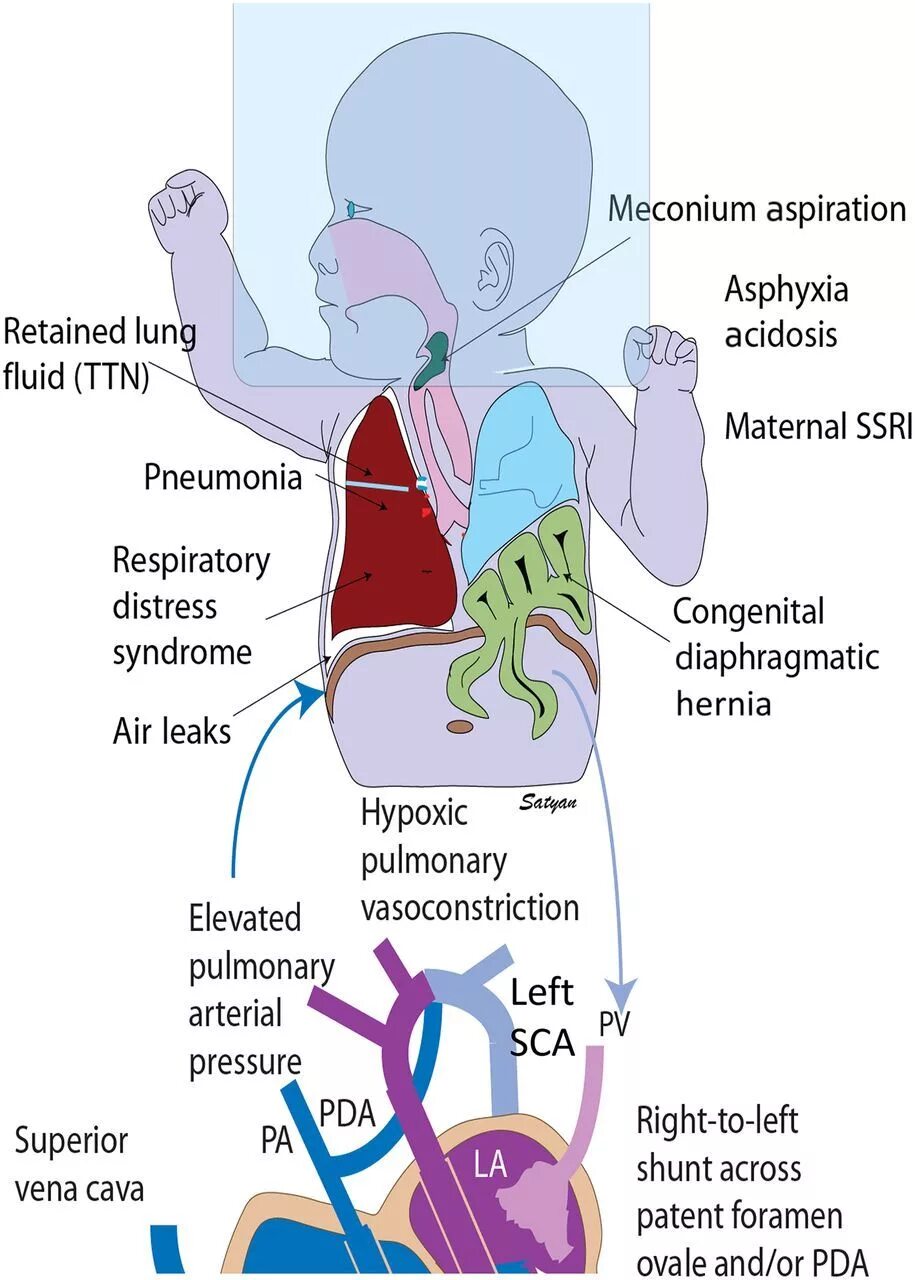 Патогенез легочной гипертензии у новорожденных. Сердце новорожденного анатомия. Легочной гипертензии у новорожденных системная. Легочная гипертензия у новорожденного