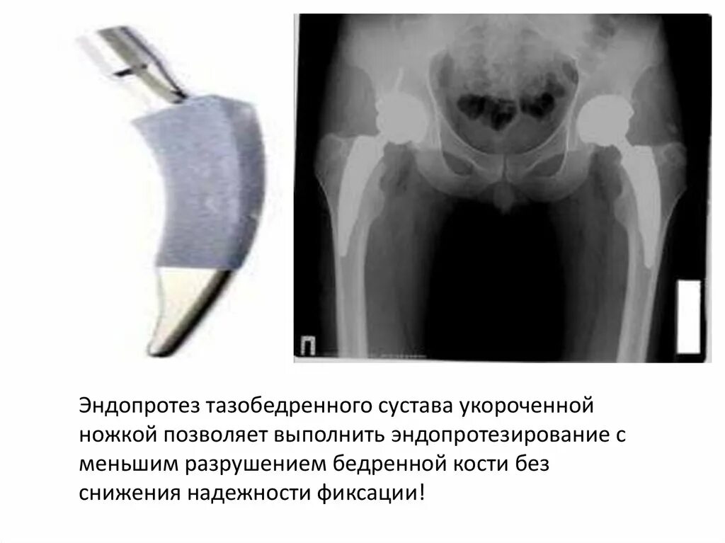 Тотальное и однополюсное эндопротезирование тазобедренного сустава. Однополюсный эндопротез тазобедренного. Однополюсный эндопротез тазобедренного сустава. Монополярный эндопротез тазобедренного сустава.