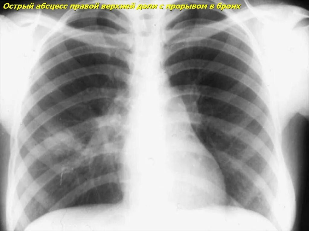 После абсцесса легкого. Абсцесс легкого рентген. Абсцесс легкого снимки. Блокированный абсцесс легкого это.