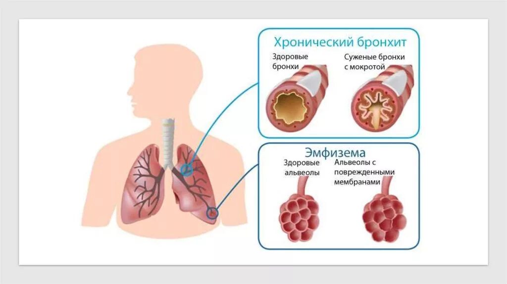Бронхит 2024. Обструктивный бронхит бронхи. Факторы способствующие развитию острого бронхита. Острый хронический бронхит клинические симптомы. Острый бронхит обструктивный и необструктивный.