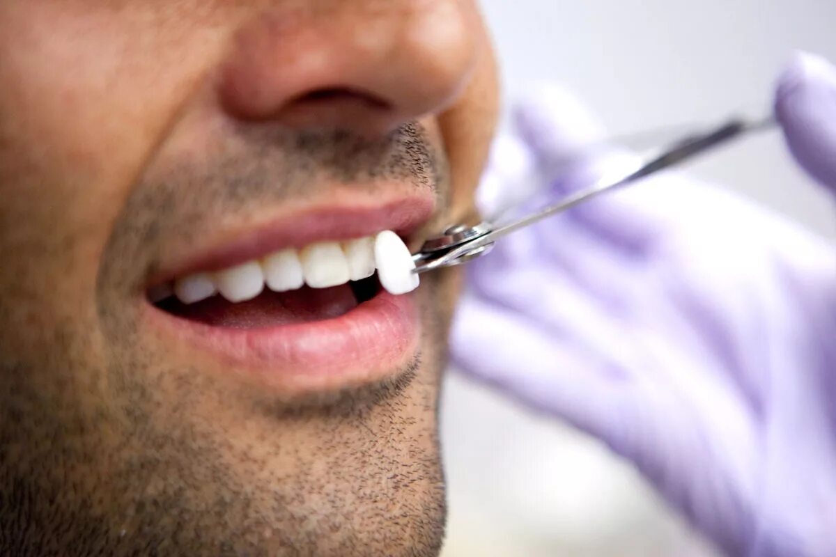 Врач который ставит зубы. Красивые зубы. Красивые зубы мужские. Виниры стоматология. Красивые зубы стоматология.