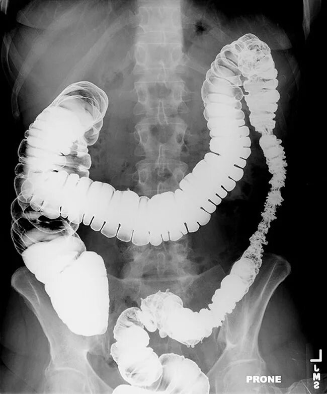 Рентген можно сделать. Ирригоскопия Толстого кишечника. Ирригоскопия Толстого кишечника рентген. Рентгенологическое исследование Толстого кишечника (ирригоскопия).. Рентген Толстого кишечника с барием.