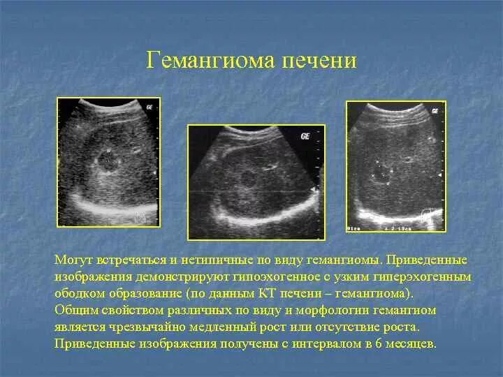 Кавернозная гемангиома селезенки УЗИ. Кавернозная гемангиома печени на УЗИ. Гемангиома селезенки на УЗИ. Гемангиома новообразование.