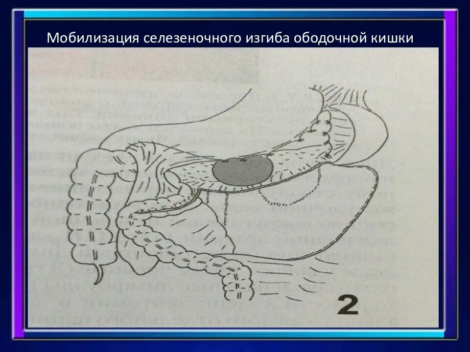 Правосторонняя гемиколэктомия. Селезеночный изгиб ободочной кишки. Мобилизация ободочной кишки.
