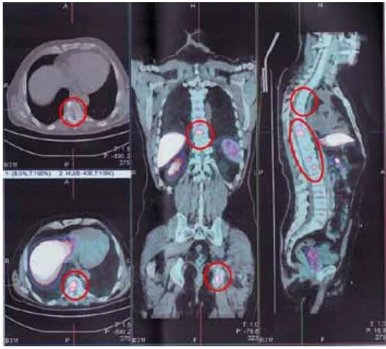 ПЭТ-кт опухоль позвоночника. Метастазы в костях позвоночника на кт.