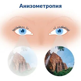 Анизометропия глаза