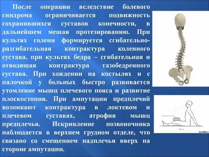 Диагноз ампутация нижних конечностей