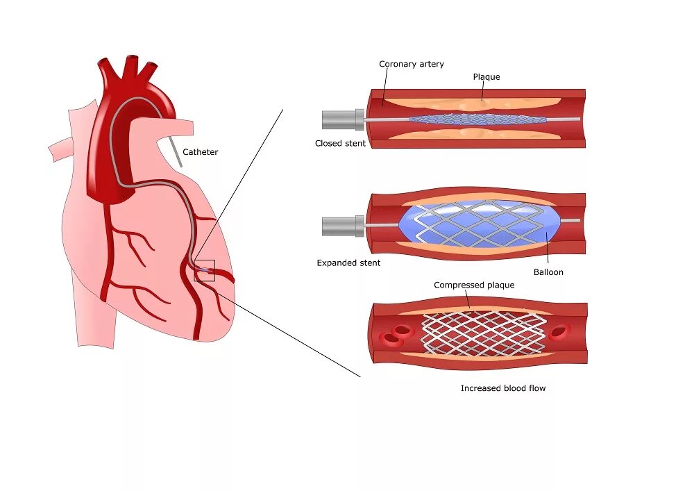 Стентирование коронарных артерий сердца. Стентировние корнараеыц атерии. Операция стентирование сосудов сердца. Коронарных сосудов после стентов. Стент 2