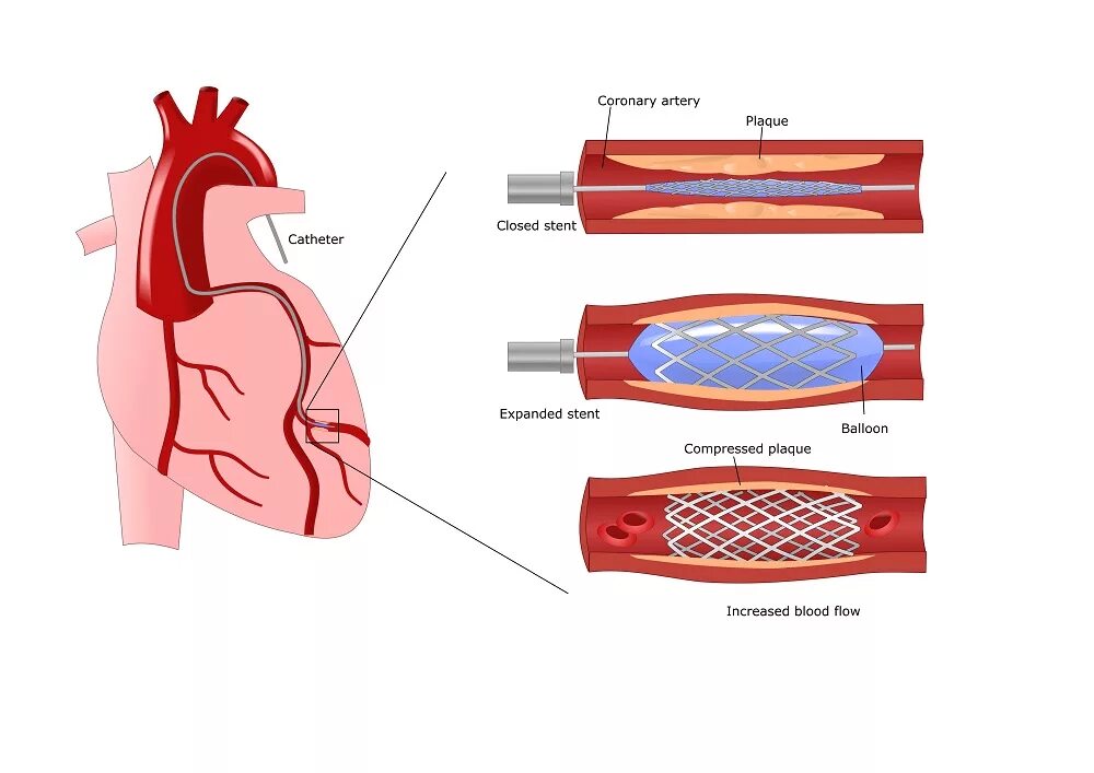 Сколько стоит стент. Стентирование коронарных артерий сердца. Стентировние корнараеыц атерии. Операция стентирование сосудов сердца. Коронарных сосудов после стентов.