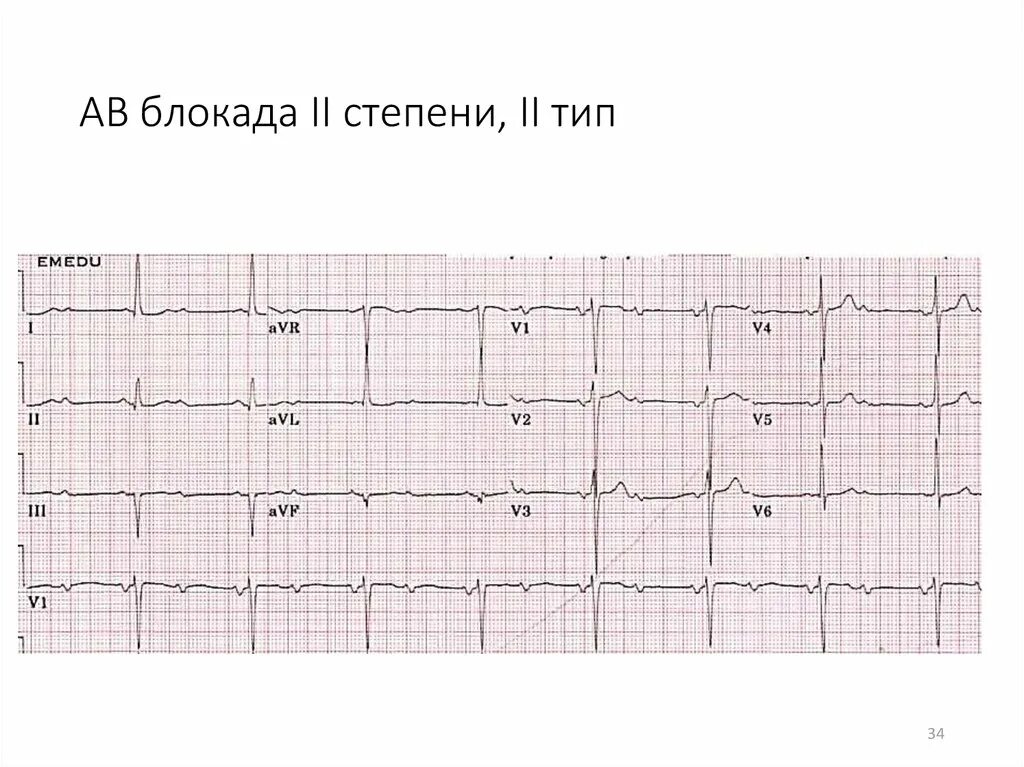 Атриовентрикулярная блокада 2. АВ блокада 2 степени типа 1 Мобитц 1 это. АВ блокада 2 степени, 1 Тип (Мобиц 1). ЭКГ атриовентрикулярная блокада II степени Мобитц 2. АВ блокада 2 степени типа Мобитц 2.