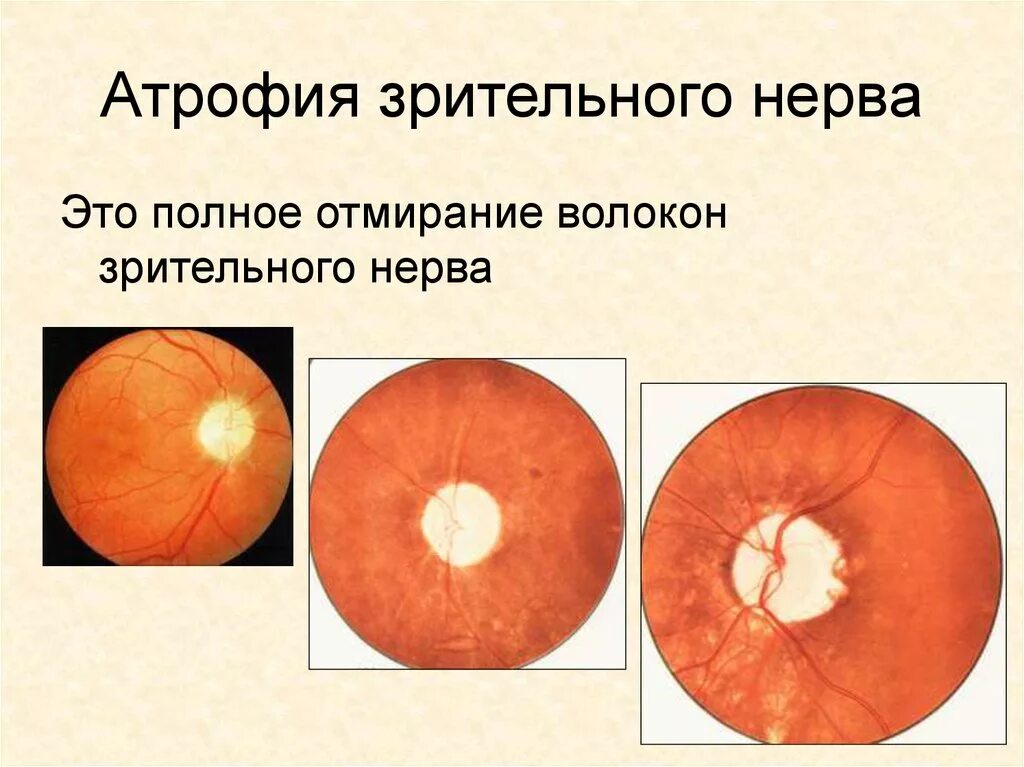 Тип зрительного нерва. Нейропатия зрительного нерва Лебера. Частичная атрофия зрительного нерва врожденная. Омертвление зрительного нерва. Причины развития атрофии зрительного нерва.