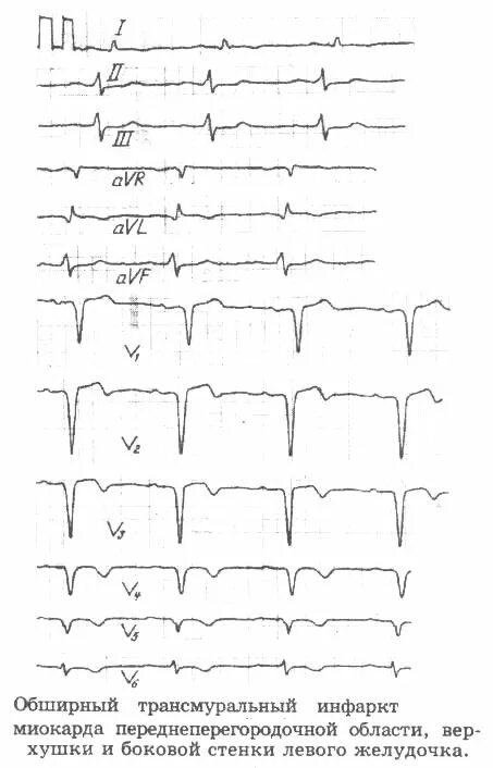 Изменение миокарда передне перегородочной области. Трансмуральный инфаркт миокарда на ЭКГ. Стадии трансмурального инфаркта миокарда на ЭКГ. Переднеперегородочный инфаркт миокарда на ЭКГ. Инфаркт миокарда переднеперегородочной области на ЭКГ.