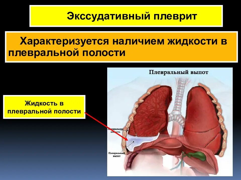 Экссудативный плеврит. Транссудативный плеврит. Сухой и выпотной плеврит. Плевральные осложнения