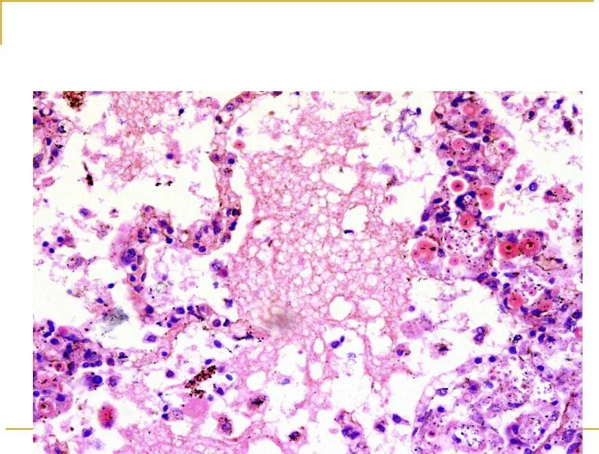 Геморрагическая пневмония гистология. Пневмоцистная пневмония патологическая анатомия. Абсцедирующая пневмония гистология. Межуточная пневмония гистология. Медуллобластома гистология.