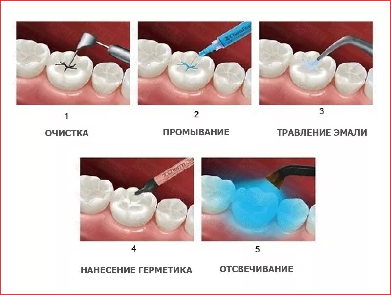 Герметизация фиссур - защита зубов у детей от кариеса
