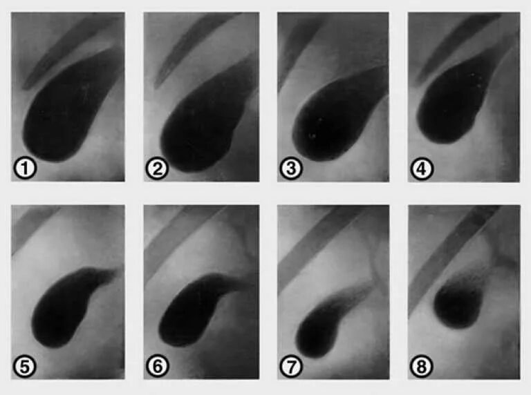Пероральная холецистография. Холецистография рентгенологическое исследование. Холецистография с пероральным контрастированием. Холецистография желчнокаменная болезнь. Препараты для пероральной холецистографии.
