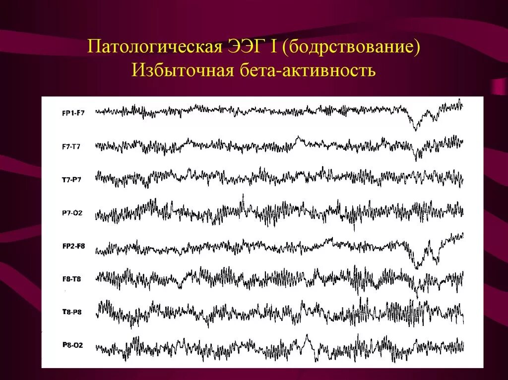 Запись на ээг. Эпилептиформные паттерны на ЭЭГ. Патологическая форма активности ЭЭГ:. ЭЭГ волны патологические. Патологическая ЭЭГ бодрствование.