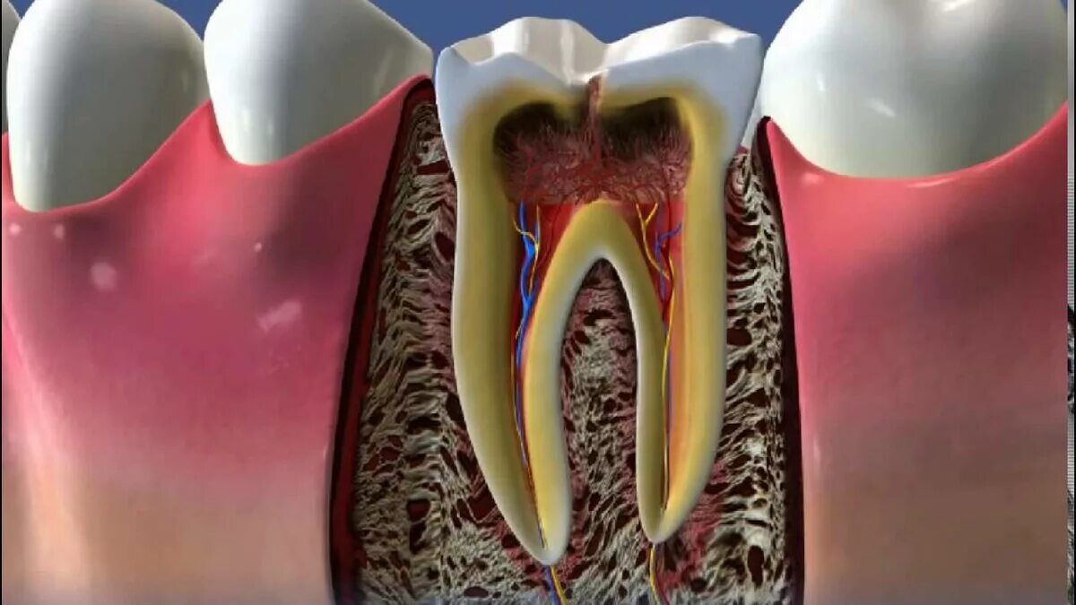 Осложнения лечения пульпита. Трехкорневой периодонтит. Кариес пульпит периодонтит. Пульпит - воспаление пульпы зуба.