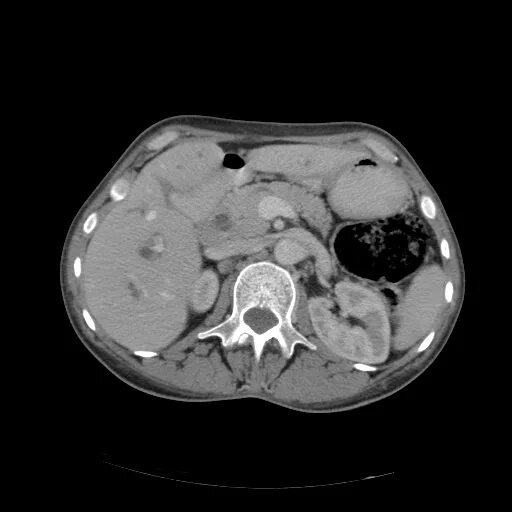 Мультиспиральная кт брюшной полости. Снимки кт брюшной полости метастазы. Кт ОБП С контрастированием. Кт брюшной полости и забрюшинного пространства с контрастом.