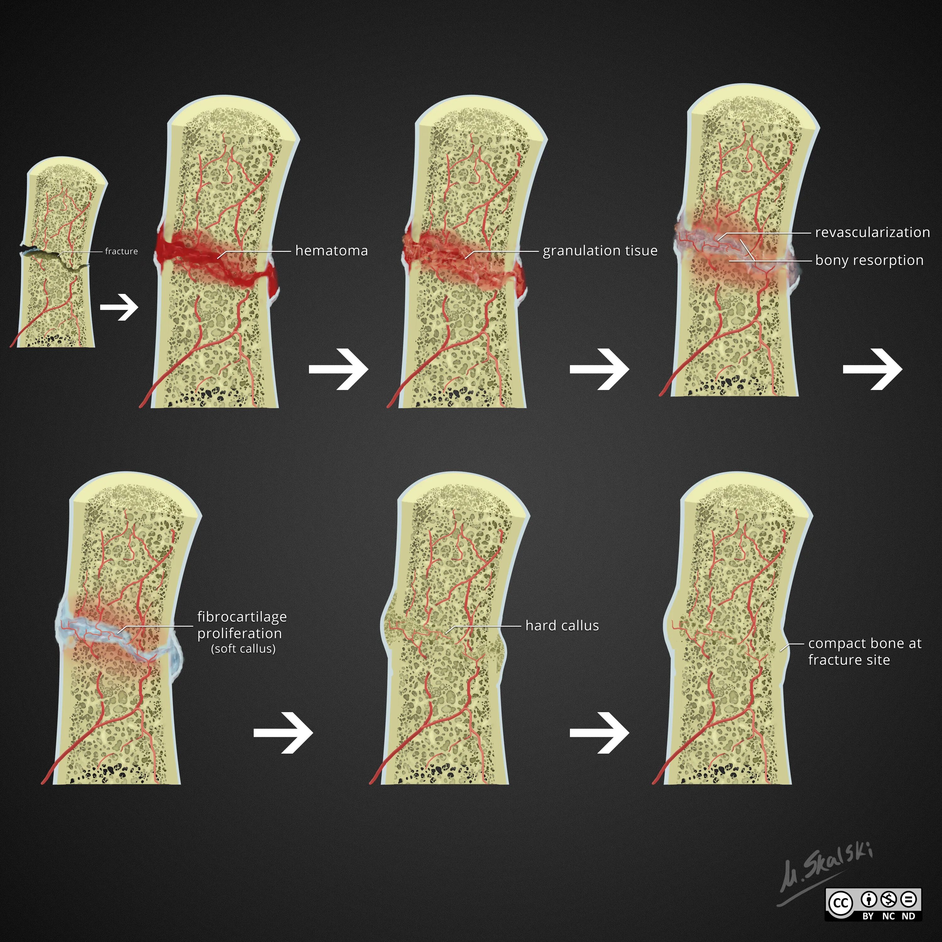 Этапы заживления перелома кости. Заживление переломов костей.