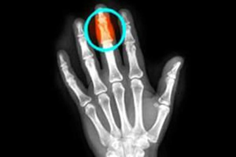 Рентген перелома средней, фаланги мизинца руки. Перелом средней фаланги пальца на руке рентген. Рентген перелома пальца мизинца. Рентген перелома фаланги большого пальца руки.