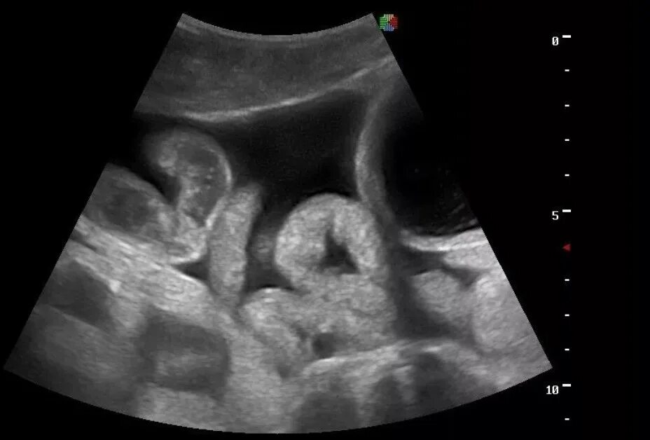 Как называется узи кишечника. Ультразвуковое исследование (узи) кишечника. Узи тонкого кишечника протокол. Опухоль толстого кишечника на узи. Как называется узи кишечника.