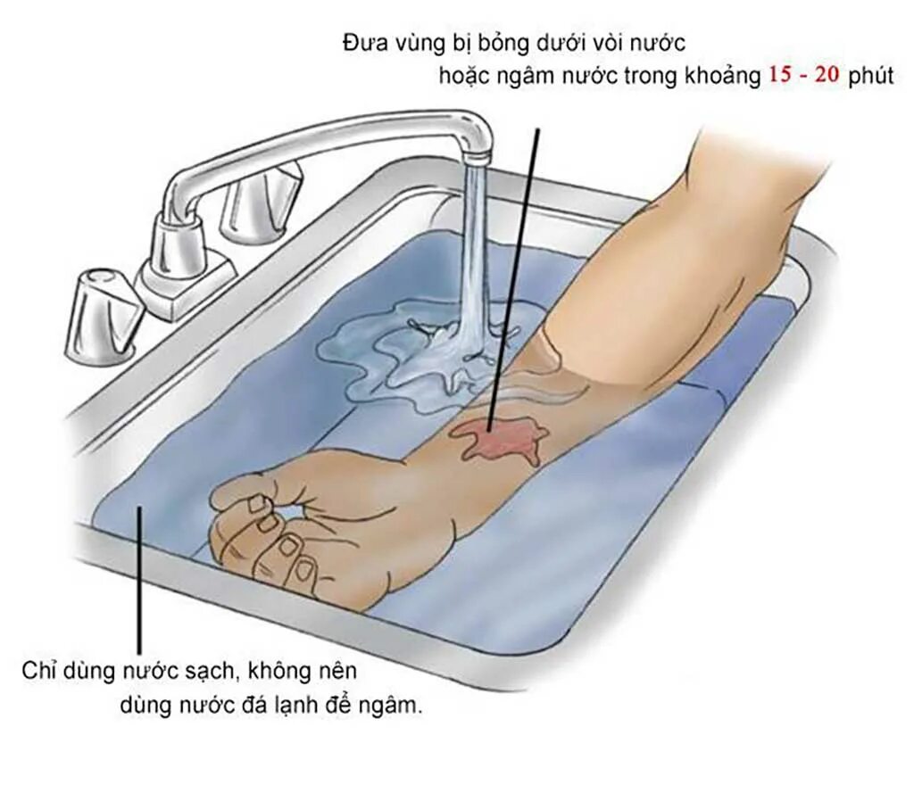 Можно промывать рану водой. Рука с ожогом под струей воды. Охлаждение при ожогах водой. Ожоги под проточной водой.