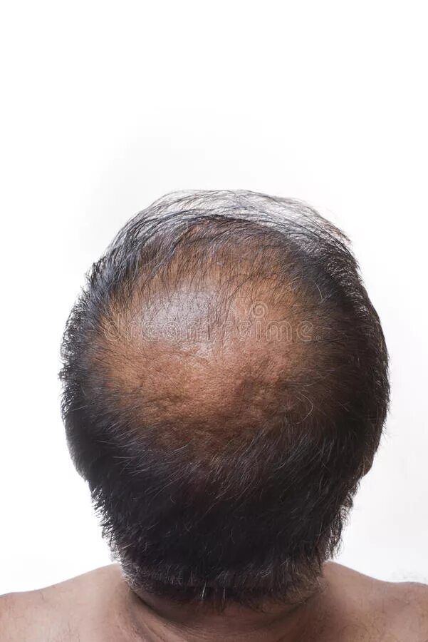 Очаговая алопеция лентовидная. Очаговая (гнездная) алопеция. Can stress cause hair loss. Сонник облысение. Сонник облысение.