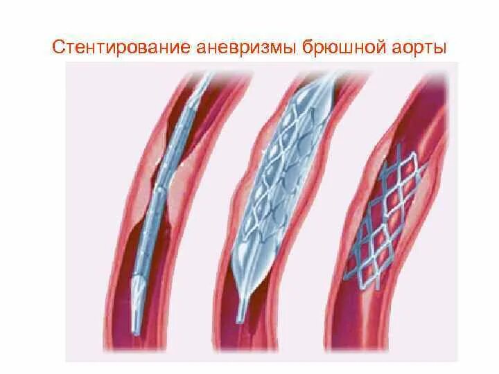 Стенты меняют