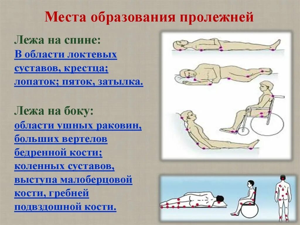 Области образования пролежней