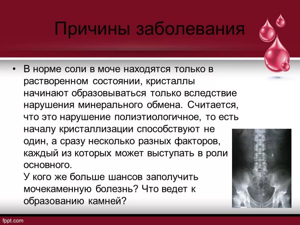 Мочекаменная болезнь мкб клиника. Мочекаменная болезнь презентация. Мочекаменная болезнь причины. Почечнокаменная болезнь причины.