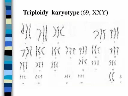 Кариотип xxy