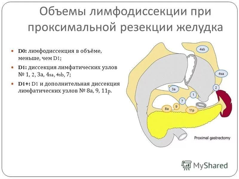 Лимфодиссекция при раке. Объемы лимфодиссекции. Резекция желудка с лимфаденэктомией. Гастрэктомия с лимфодиссекцией d2. Гастректомия с лимфодтсекцие d 2.