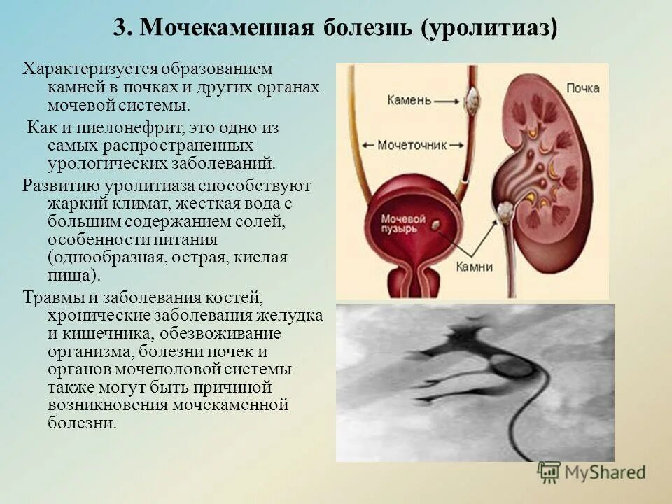 Причины заболевания почек биология. Почечнокаменная болезнь механизмы образования почечных камней. Мочекаменная болезнь урология камни мочеточника. Заболевания мочевыделительной системы мочекаменная болезнь. Мочеполовой системы - мочекаменная болезнь.