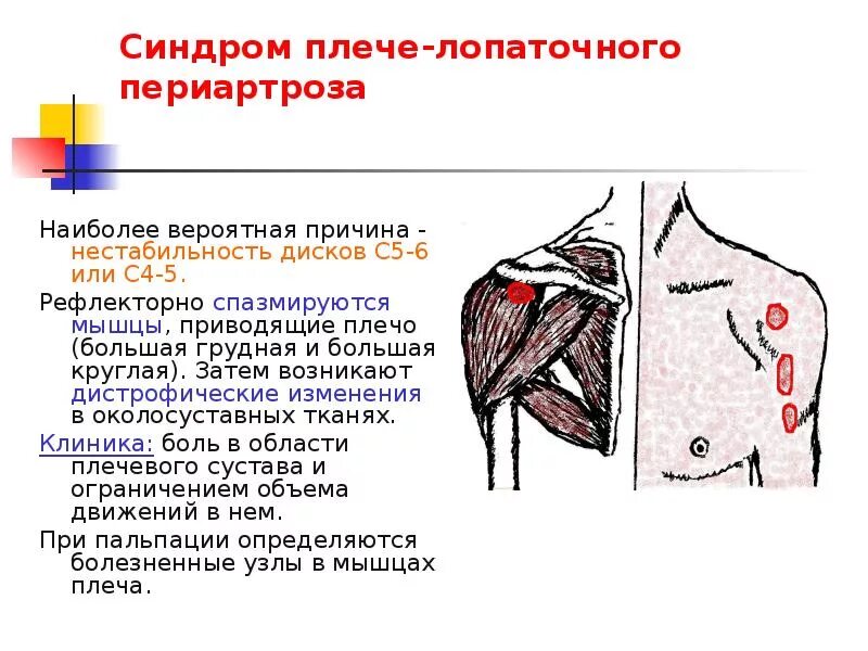 Синдром сдавления ротатора плеча. Плечелопаточный периартрит импиджмент синдром. субакромиальный импичмент синдром плечевого сустава. импиджмент синдром левого плечевого сустава. импичмент синдром плечевого сустава это.