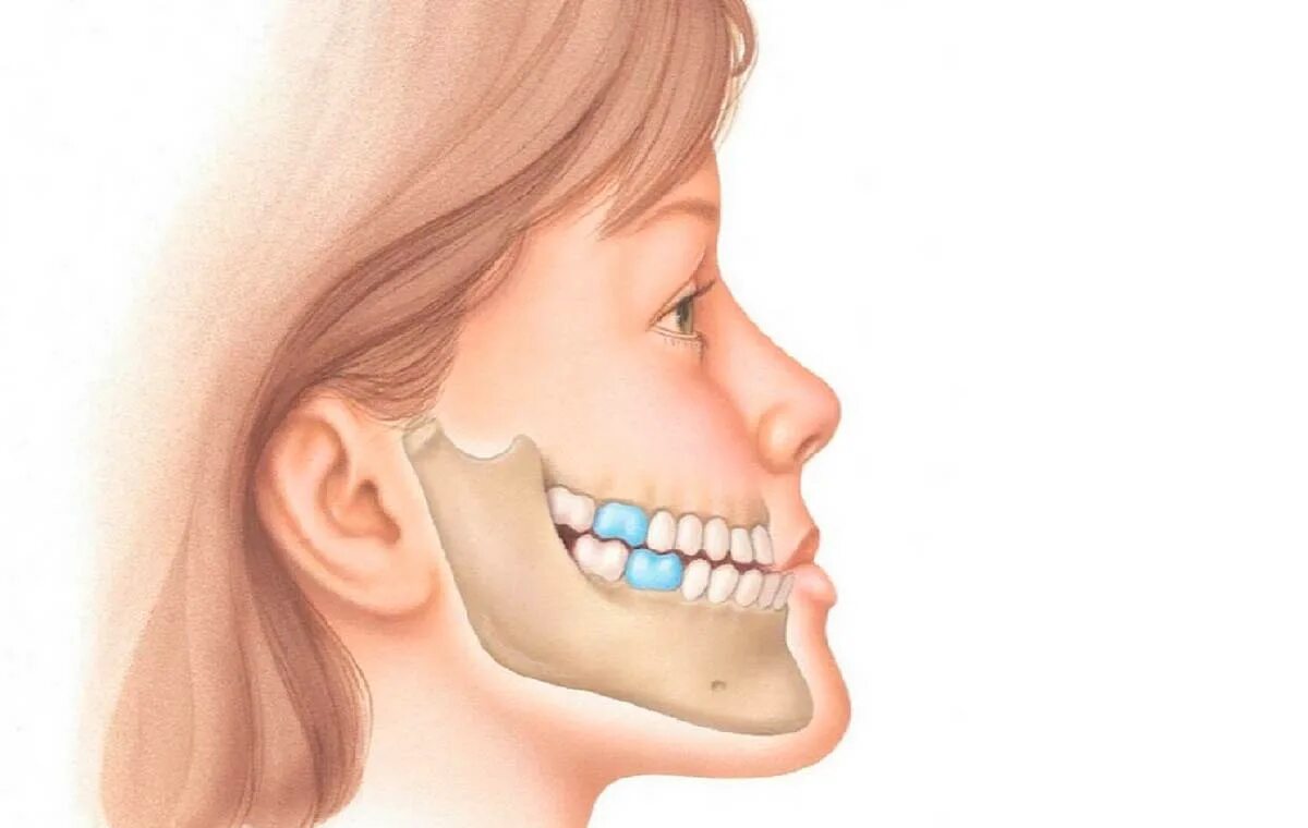Зубы при закрытом рте. Микрогнатия недоразвитие нижней челюсти. Микрогнатия верхней челюсти. Дистальный прикус (прогнатический прикус). Мезиальный прикус Энгля.