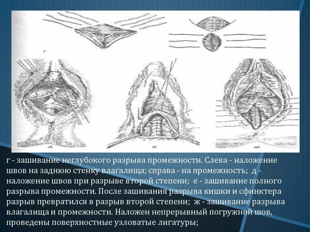 Ушивание разрывов. Ушивание разрыва промежности 2 степени. Разрыв задней стенки влагалища. Ушивание разрывов промежности методика. Степени разрыва промежности.