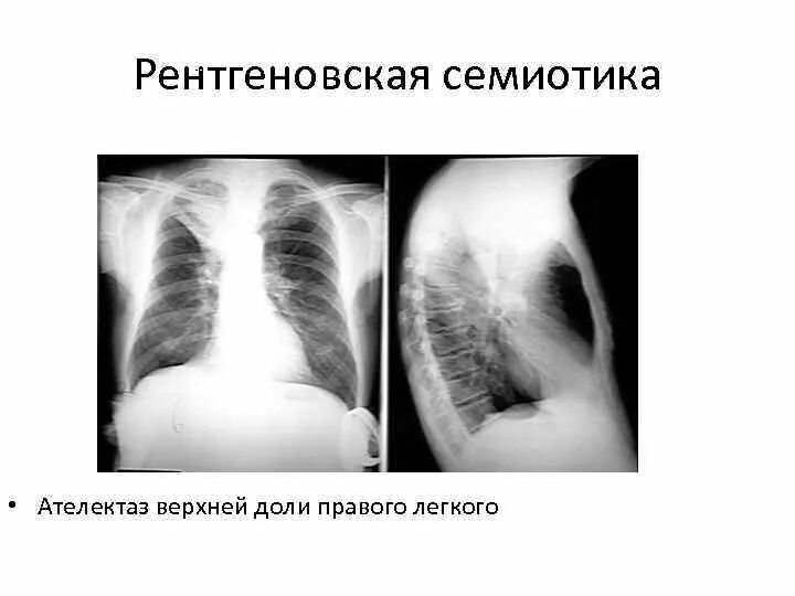 Рентгенологические признаки ателектаза. Долевой ателектаз на рентгене. Рентгенологические признаки ателектаза. Дисковидный ателектаз рентген. Ателектаз доли легкого рентген.